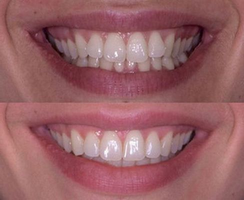 Precios ortodoncia invisible en GandÃ­a