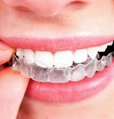 Precio ortodoncia invisible en Aspe